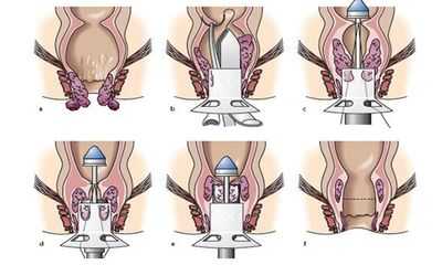 Ход операции геморроидопексии