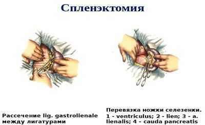 Спленэктомия