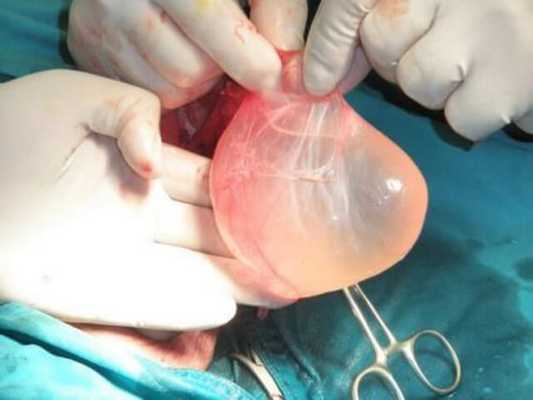 Операция Бергмана при водянке яичка