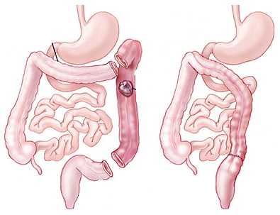 Операция на кишечнике