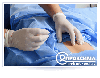 Вскрытие абсцесса эпителиального копчикового хода