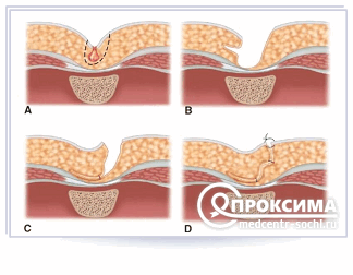 Киста копчика