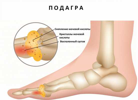 Подагра.jpg