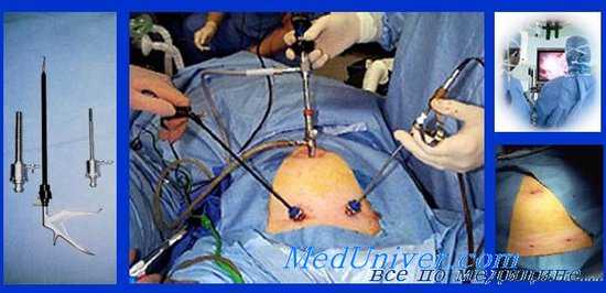 Показания к лапароскопии. Лапароскопия при травме живота