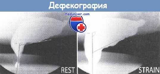 Дефекография