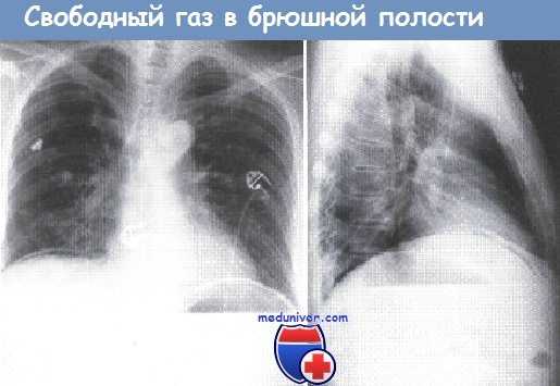 Газ в брюшной полости на рентгенограмме