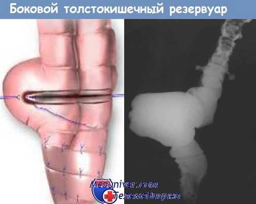 Боковой толстокишечный резервуар