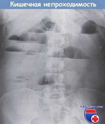 Кишечная непроходимость на рентгенограмме