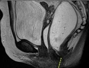 Рентгенографическая дефекография