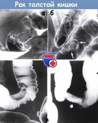 Колоректальный рак - рак толстой кишки