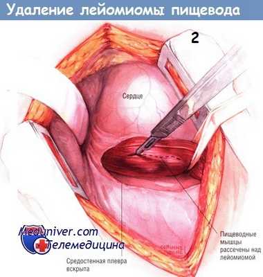 Методика операции удаления лейомиомы пищевода