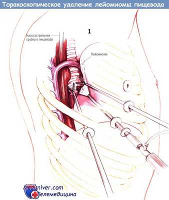 Доступы торакоскопического удаления лейомиомы пищевода