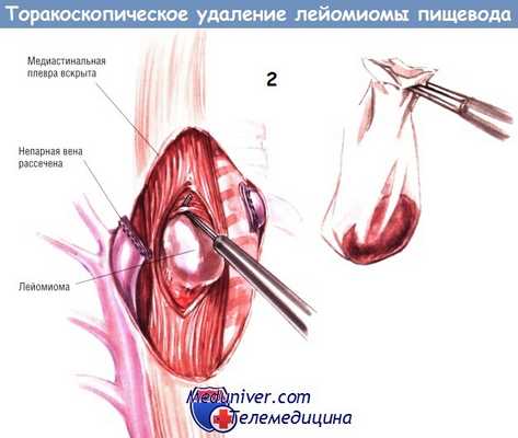 Методика торакоскопического удаления лейомиомы пищевода