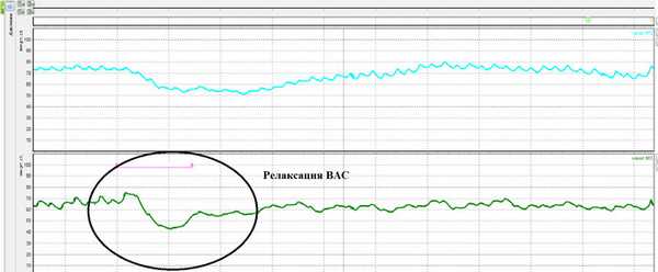 РАИР оценивается по каналам 2-4 – фиксируется минимальный объем воздуха в баллончике, способный вызвать релаксацию . В данном примере релаксация ВАС возникла при объеме баллончика 40 мл (Парфенов А.И. и др.)