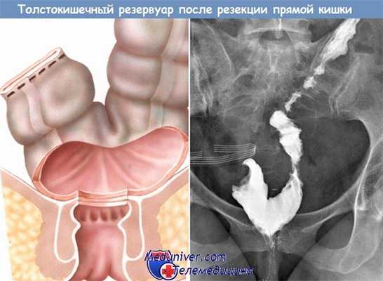 Толстокишечный резервуар после резекции прямой кишки