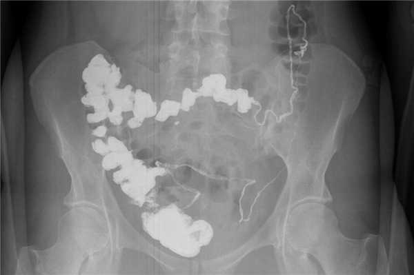 Рентгенография пассажа бария