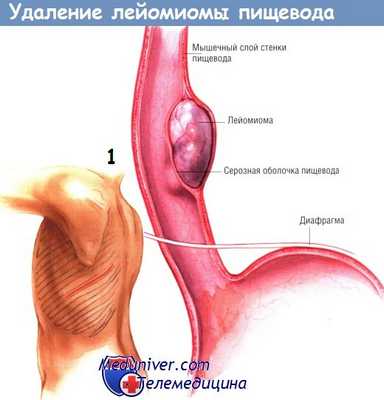Доступ при удалении лейомиомы пищевода