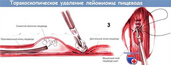 Методика торакоскопического удаления лейомиомы пищевода