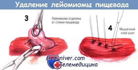 Методика операции удаления лейомиомы пищевода