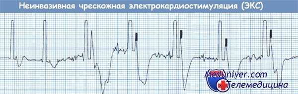 Неинвазивная чрескожная электрокардиостимуляция (ЭКС)