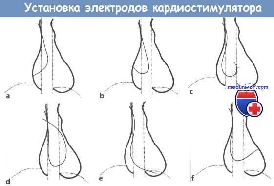 Установка электродов кардиостимулятора