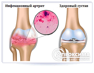инфекционные и септические артриты
