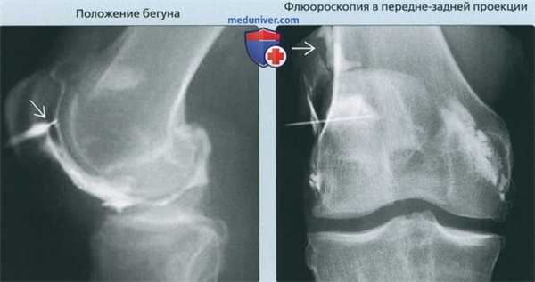 Принципы артрографии коленного сустава