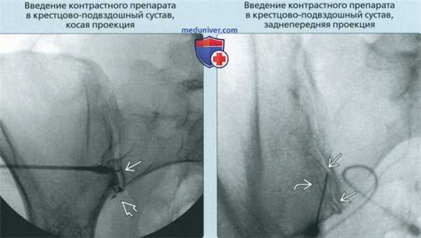 Принципы артрографии крестцово-подвздошного сустава и лобкового симфиза