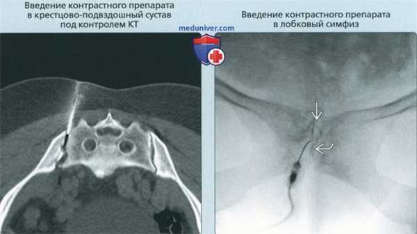 Принципы артрографии крестцово-подвздошного сустава и лобкового симфиза