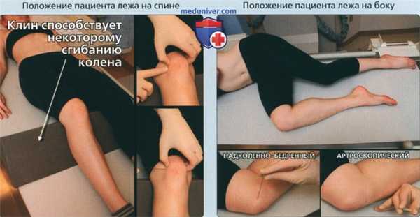 Принципы артрографии коленного сустава