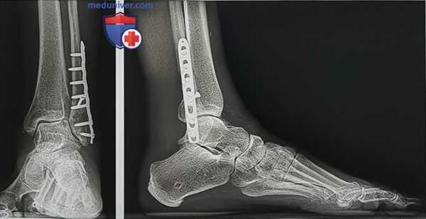 Корригирующая операция при вальгусном остеоартрите голеностопного сустава