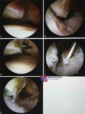 Операция при переднем импинджменте голеностопного сустава