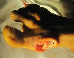 остеотомия-scarf-операция-2