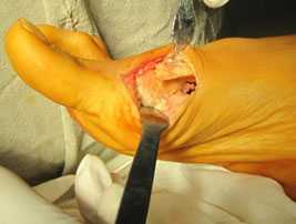 остеотомия-scarf-операция