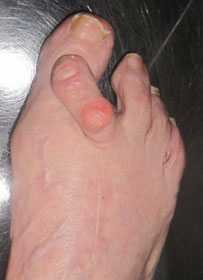 вальгусная-деформация-3