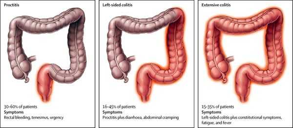 классификация колита
