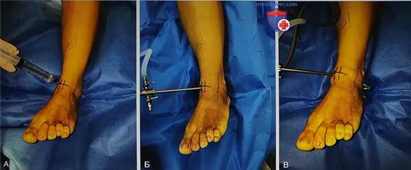 Операция при переднем импинджменте голеностопного сустава