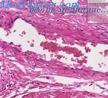 операция якобеуса