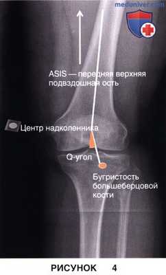 Показания, подготовка к артропластике бедренно-надколенникового сустава