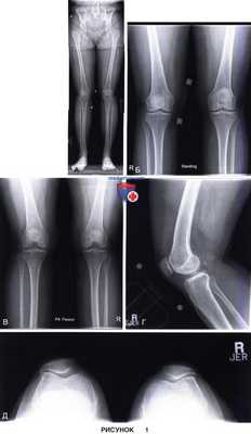 Показания, подготовка к артропластике бедренно-надколенникового сустава