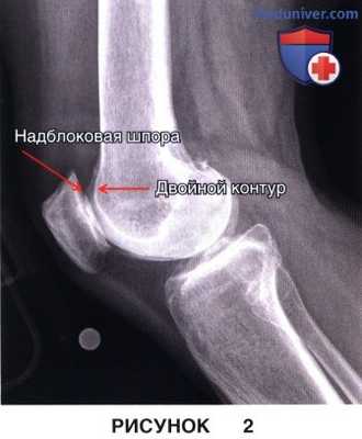 Показания, подготовка к артропластике бедренно-надколенникового сустава