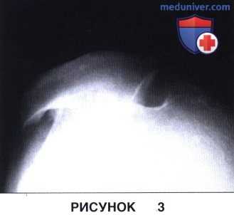 Показания, подготовка к артропластике бедренно-надколенникового сустава