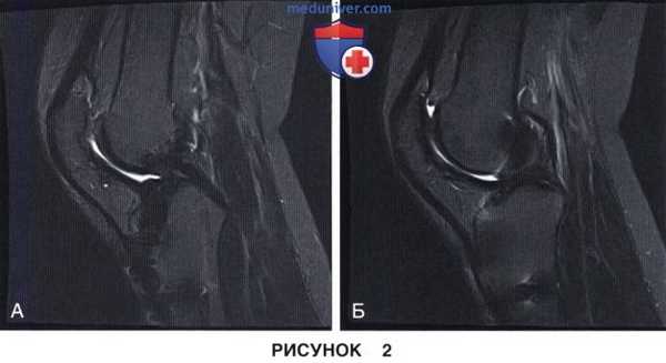 Показания и подготовка к артроскопическому артролизу коленного сустава