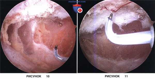 Доступ, техника артроскопического релиза и удлинения латерального удерживателя надколенника