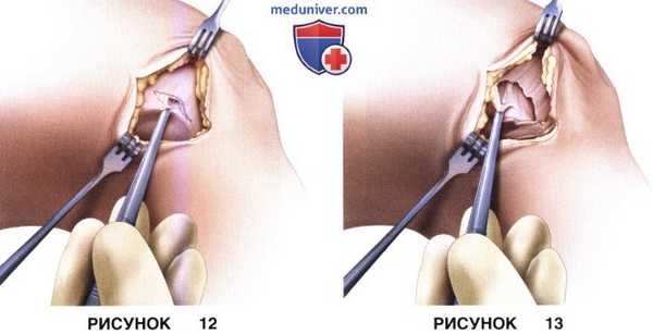 Доступ, техника артроскопического релиза и удлинения латерального удерживателя надколенника