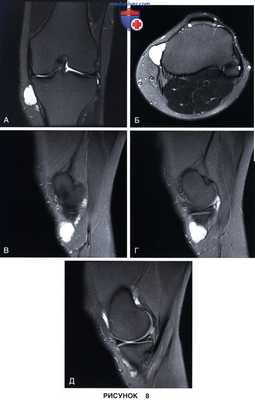 Показания и подготовка к артроскопической менискэктомии коленного сустава