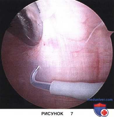 Доступ, техника артроскопического релиза и удлинения латерального удерживателя надколенника