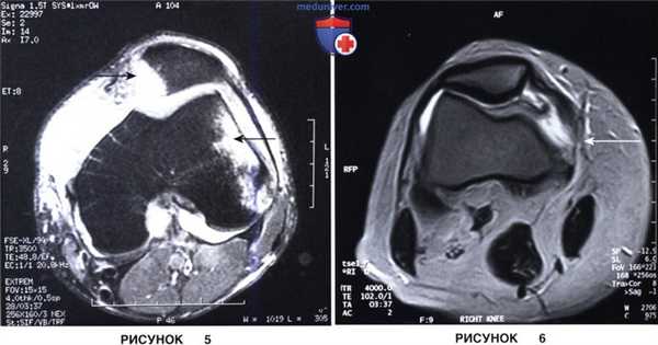 Показания, подготовка к восстановлению медиальной бедренно-надколенниковой связки при свежем вывихе надколенника