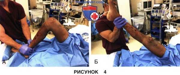 Доступ и техника артроскопического артролиза коленного сустава