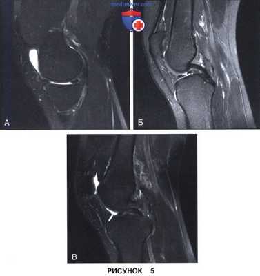 Показания и подготовка к артроскопической менискэктомии коленного сустава